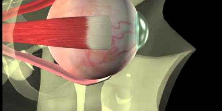 Thyroid eye disease - 12. Squint surgery - The operation